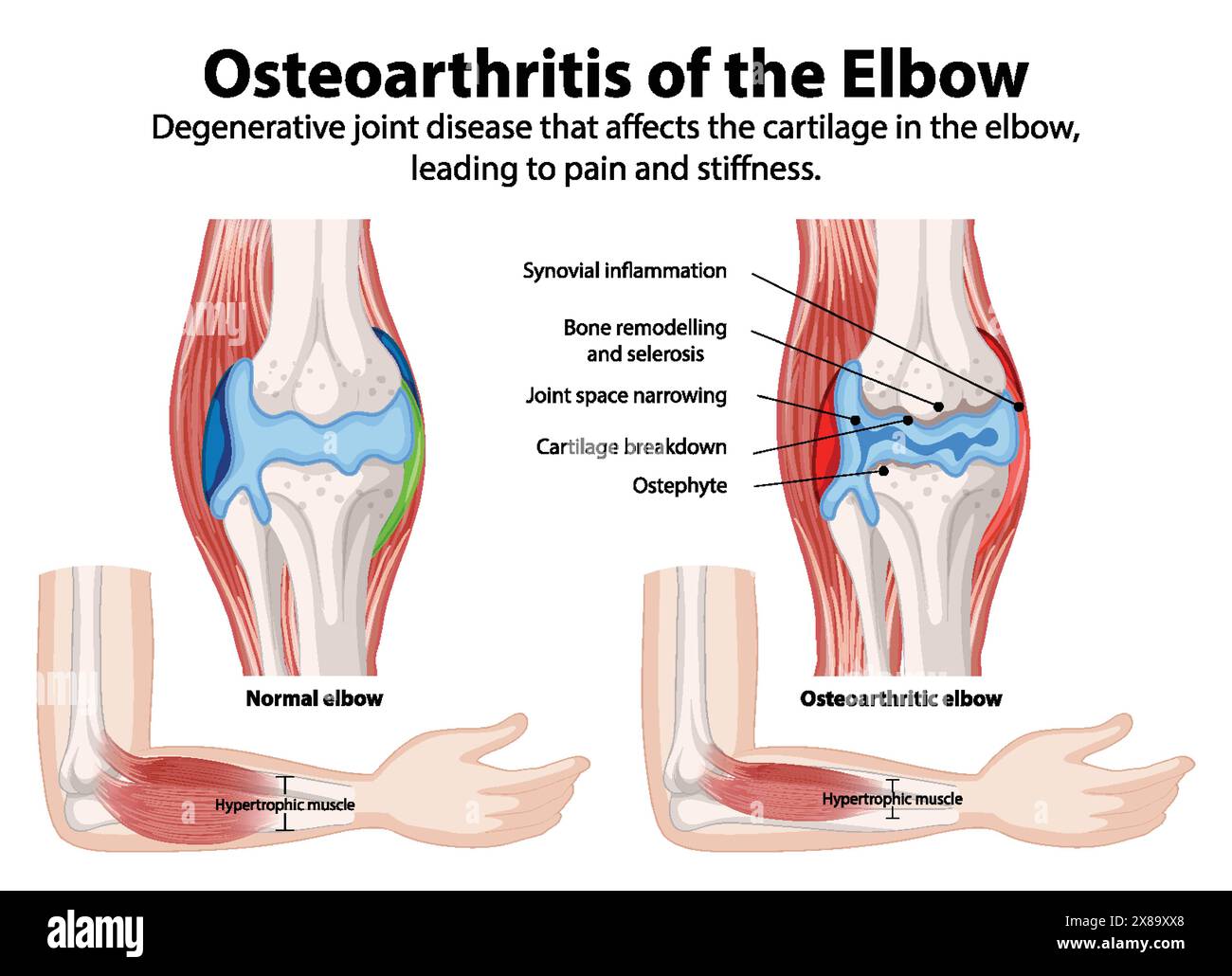 Comparaison des articulations normales et ostéo-arthritiques du coude Illustration de Vecteur