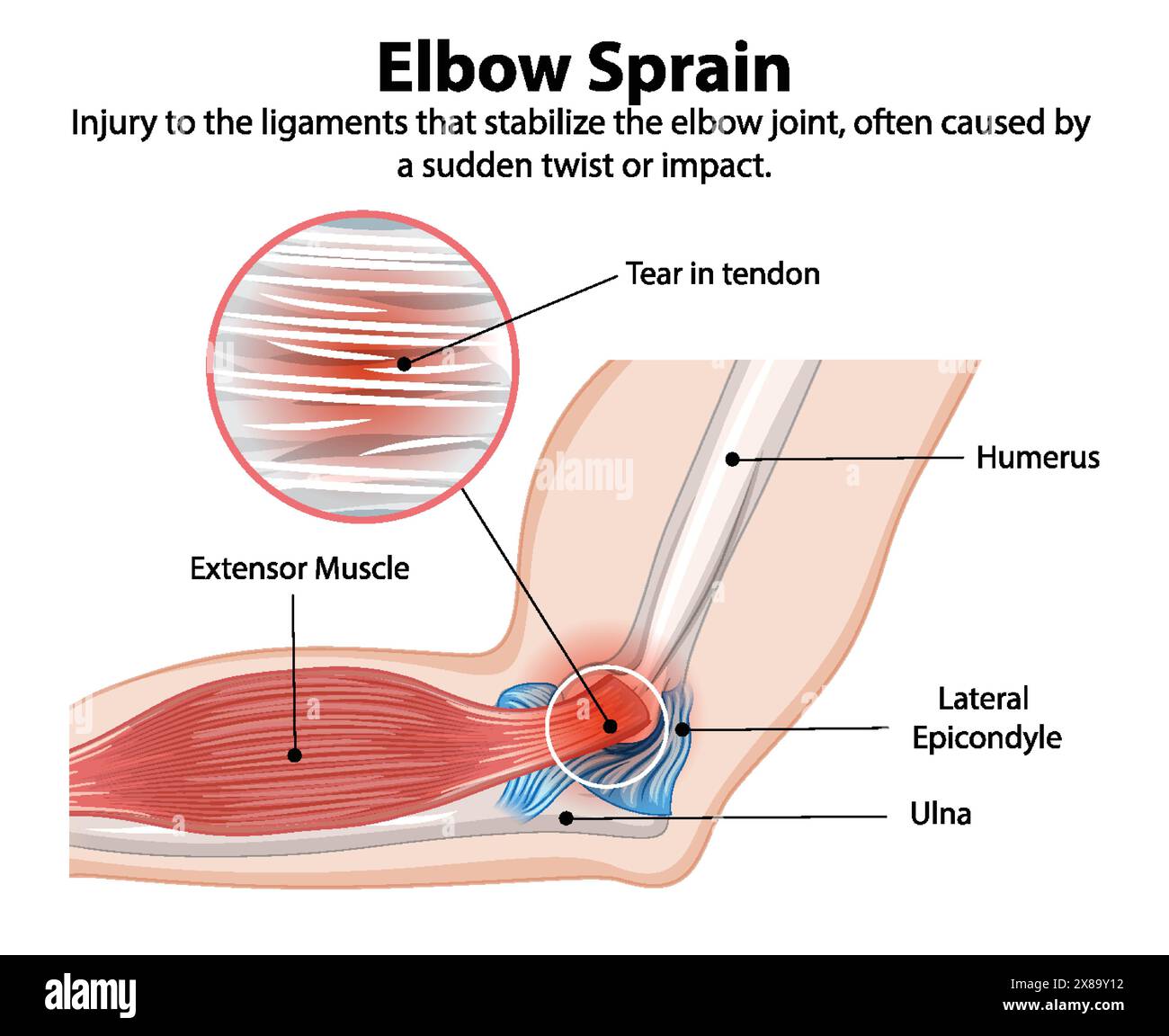 Schéma détaillé d'une entorse au coude Illustration de Vecteur