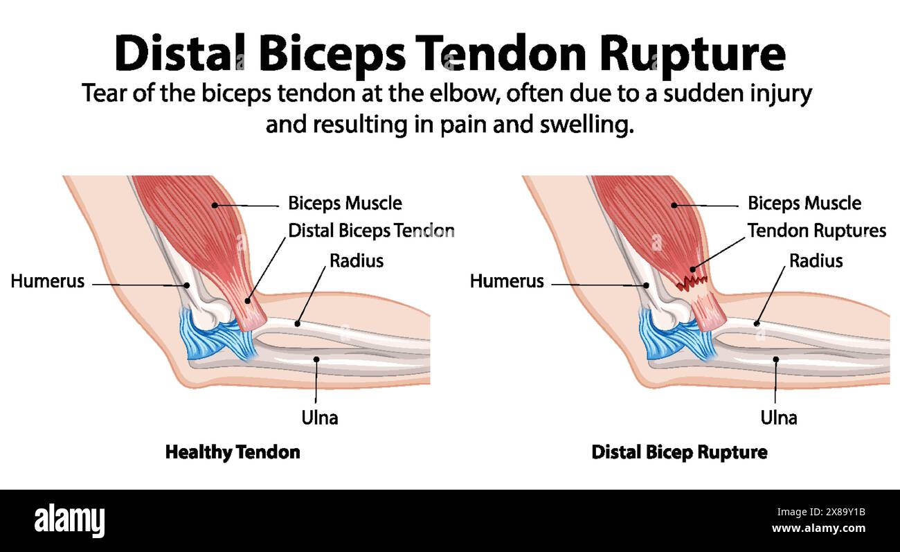 Comparaison du tendon sain et du tendon rompu du biceps Illustration de Vecteur