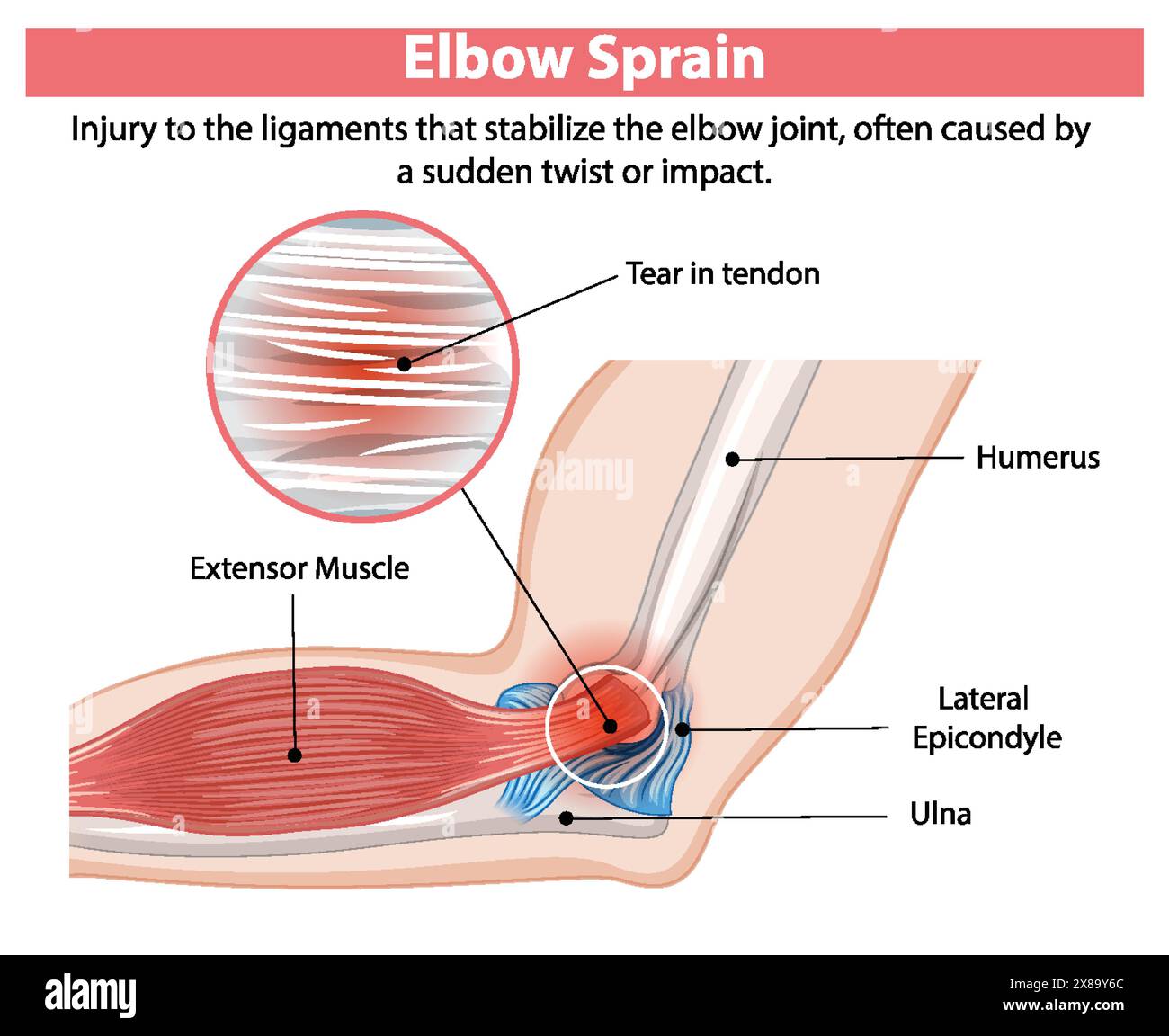 Schéma détaillé d'une entorse au coude Illustration de Vecteur