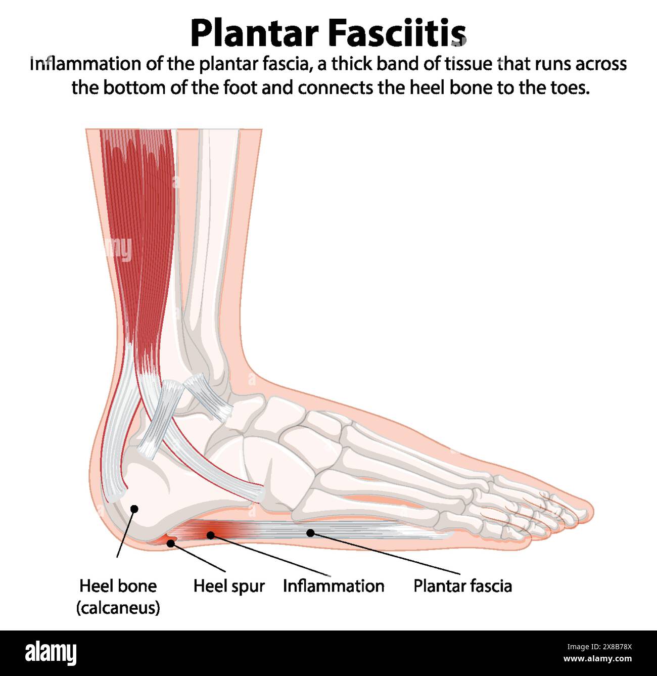 Schéma détaillé de fasciite plantaire du pied Illustration de Vecteur