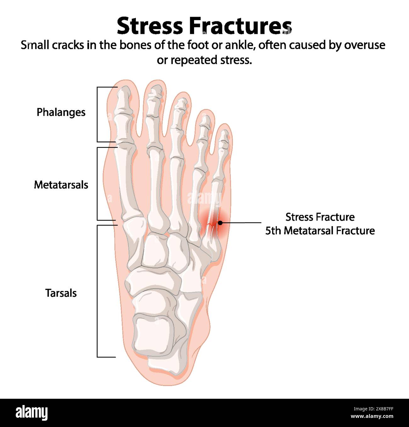 Illustration des os du pied avec fracture de stress Illustration de Vecteur