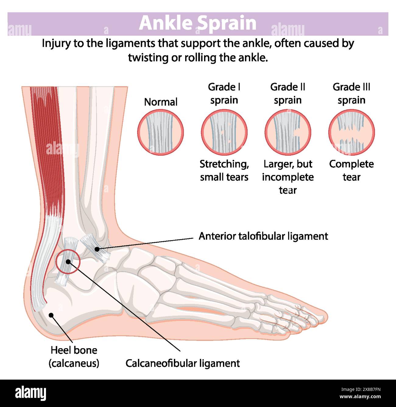 Schéma détaillé des types d'entorses de la cheville Illustration de Vecteur
