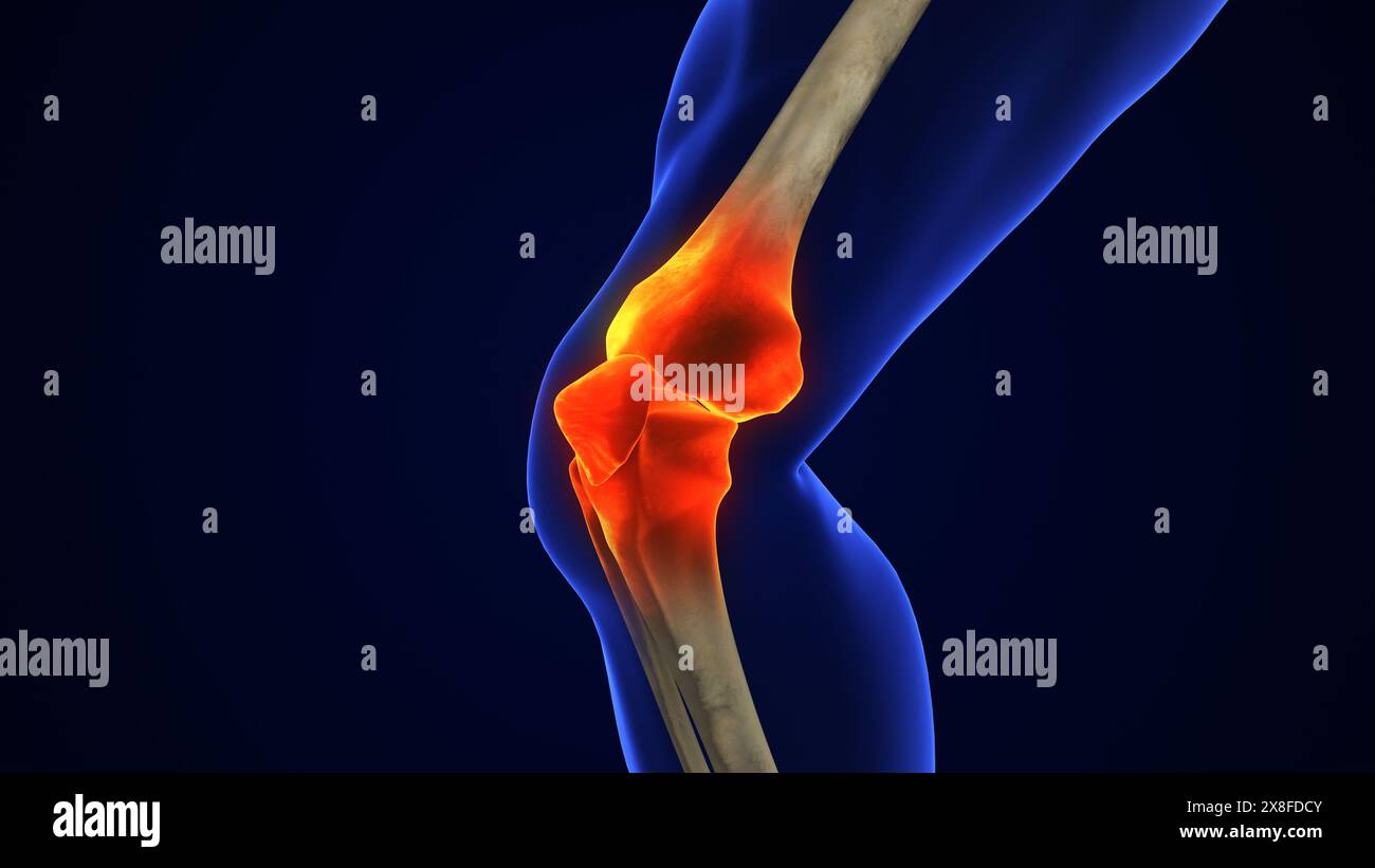 Anatomie traitement de l'articulation du genou humain, injection d'arthrose Banque D'Images