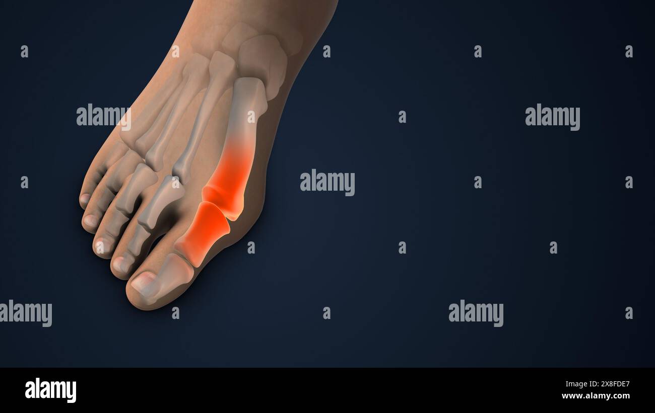 Correction hallux valgus chirurgie de la Réunion du pied Banque D'Images