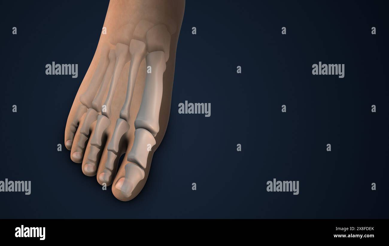 Correction hallux valgus chirurgie de la Réunion du pied Banque D'Images