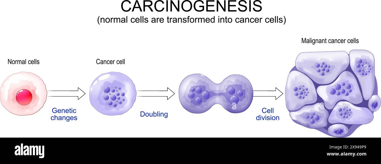 Evolution du cancer. Les cellules normales sont transformées en cancer. Carcinogenèse des mutations génétiques dans les cellules saines aux cellules cancéreuses malignes. Mutagène Illustration de Vecteur