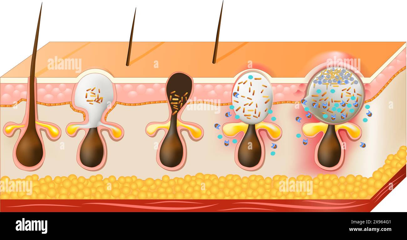 Veruci Sebacee Types de boutons d'acné. Whiteheads, Blackheads, papules et pustules ...