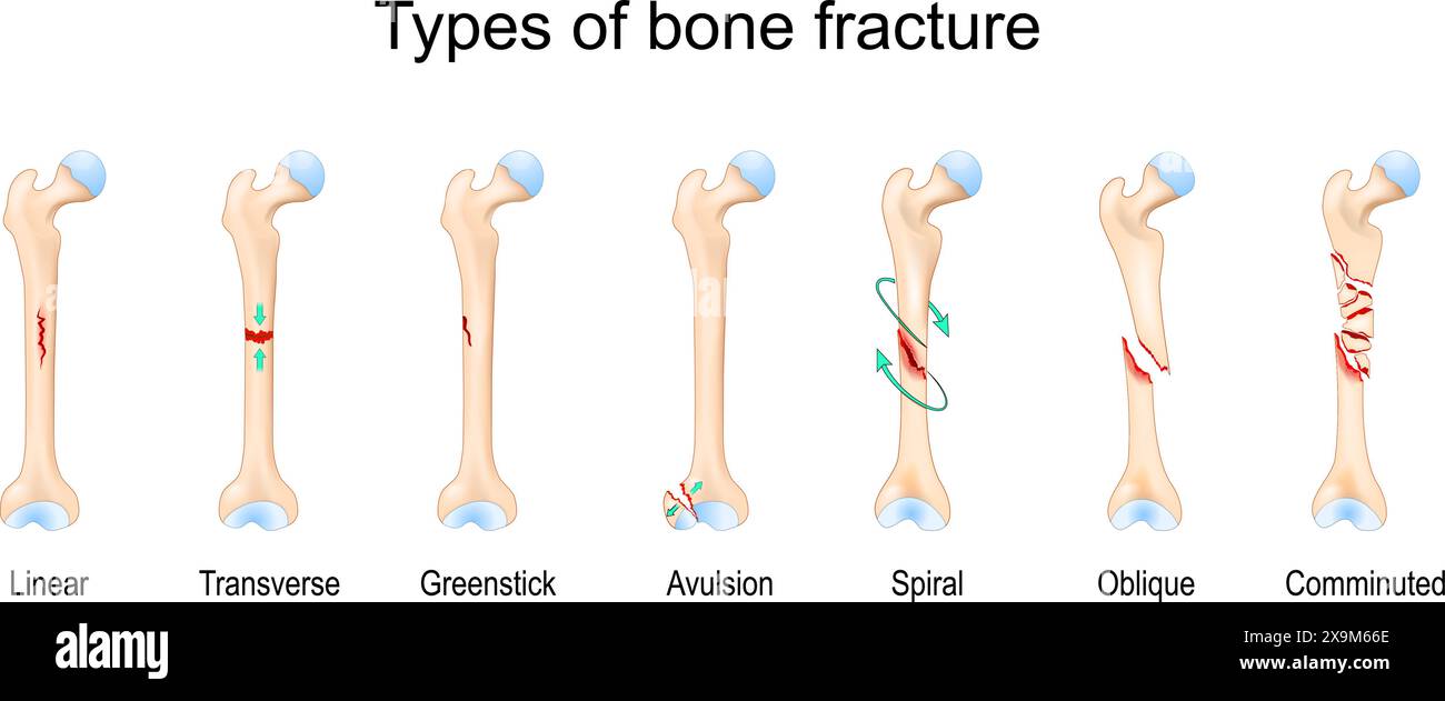 Types de fracture osseuse. OS fémoral. Illustration vectorielle. Illustration de Vecteur