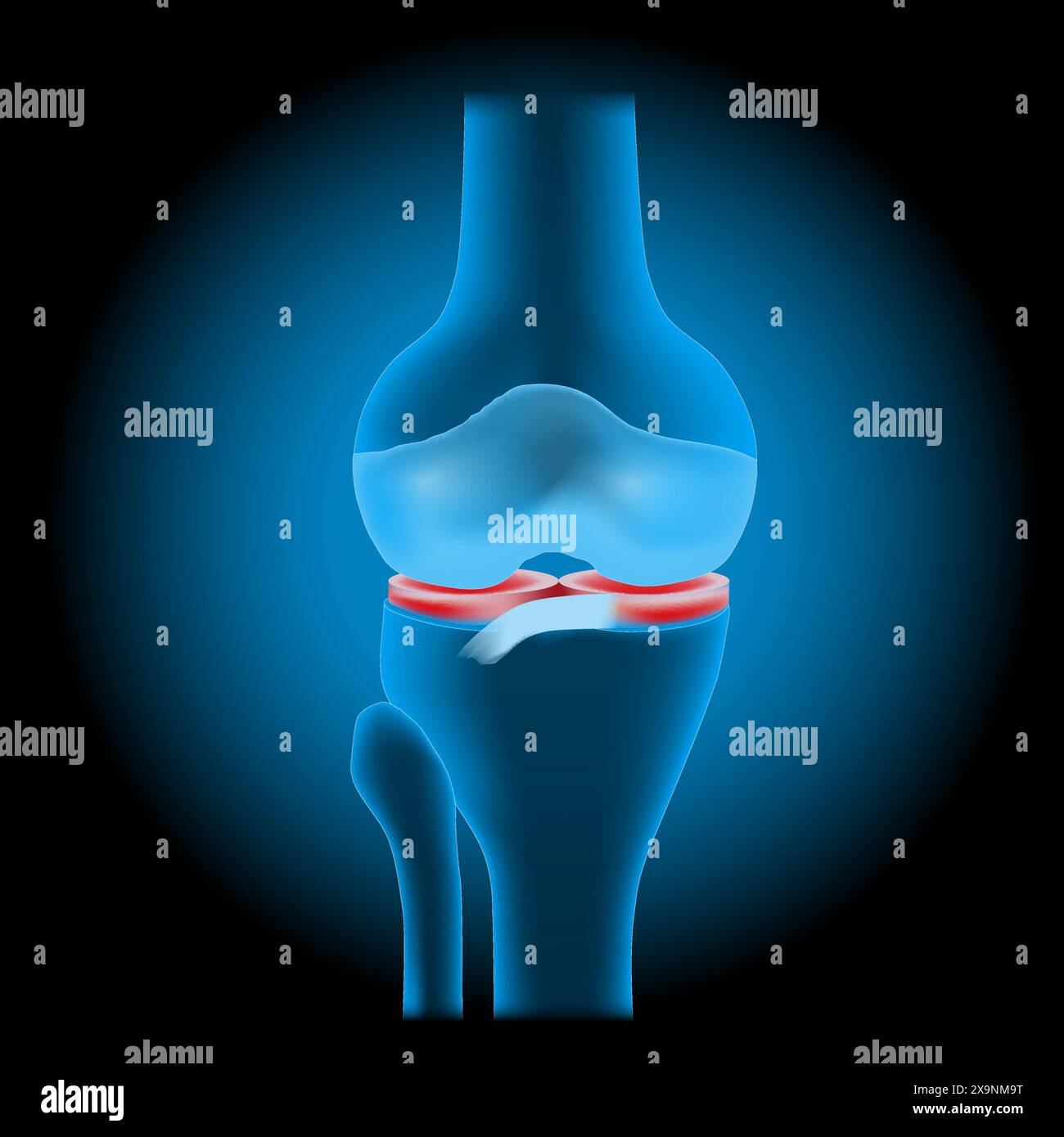 Traumatismes du ménisque du genou. Anatomie de l'articulation du genou. Joint bleu transparent réaliste avec effet lumineux sur fond sombre. Illustration vectorielle comme X-ray im Illustration de Vecteur