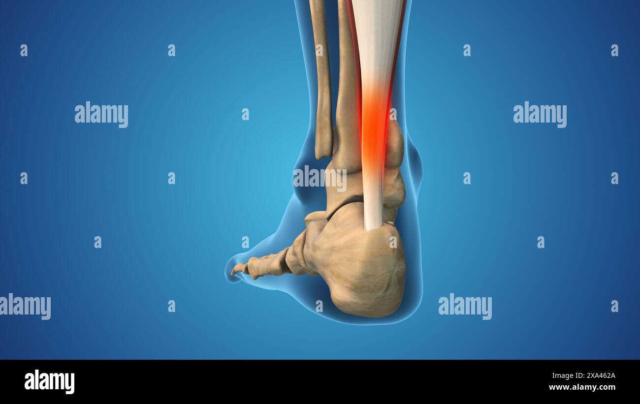 Entorse à la cheville et inflammation enflée Banque D'Images