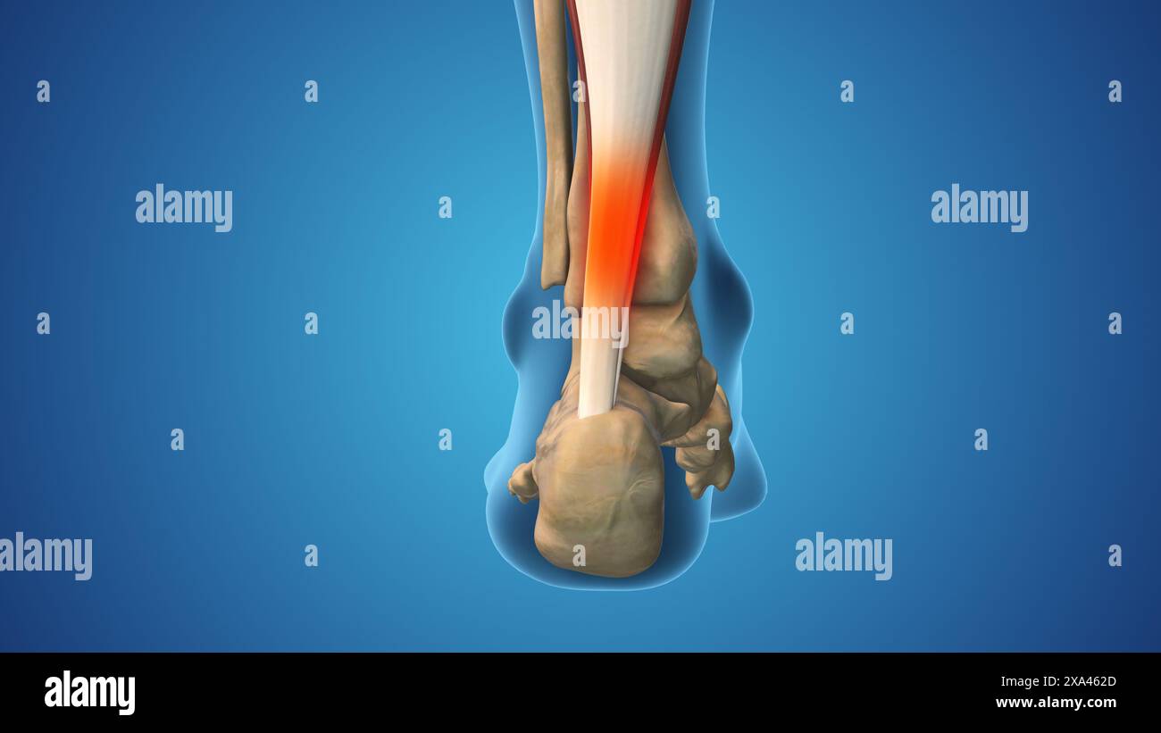 Entorse à la cheville et inflammation enflée Banque D'Images