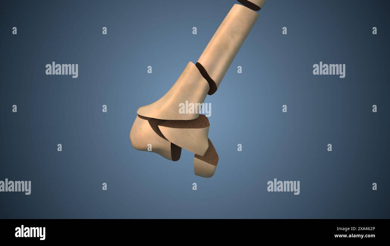 Conception médicale de l'os fissuré ou fracture osseuse Banque D'Images