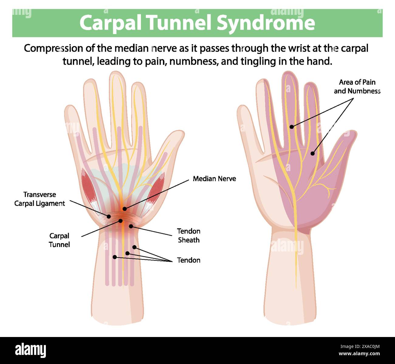 Illustration des symptômes et anatomie du syndrome du canal carpien Illustration de Vecteur Illustration des symptômes et anatomie du syndrome du canal carpien Illustration de Vecteur