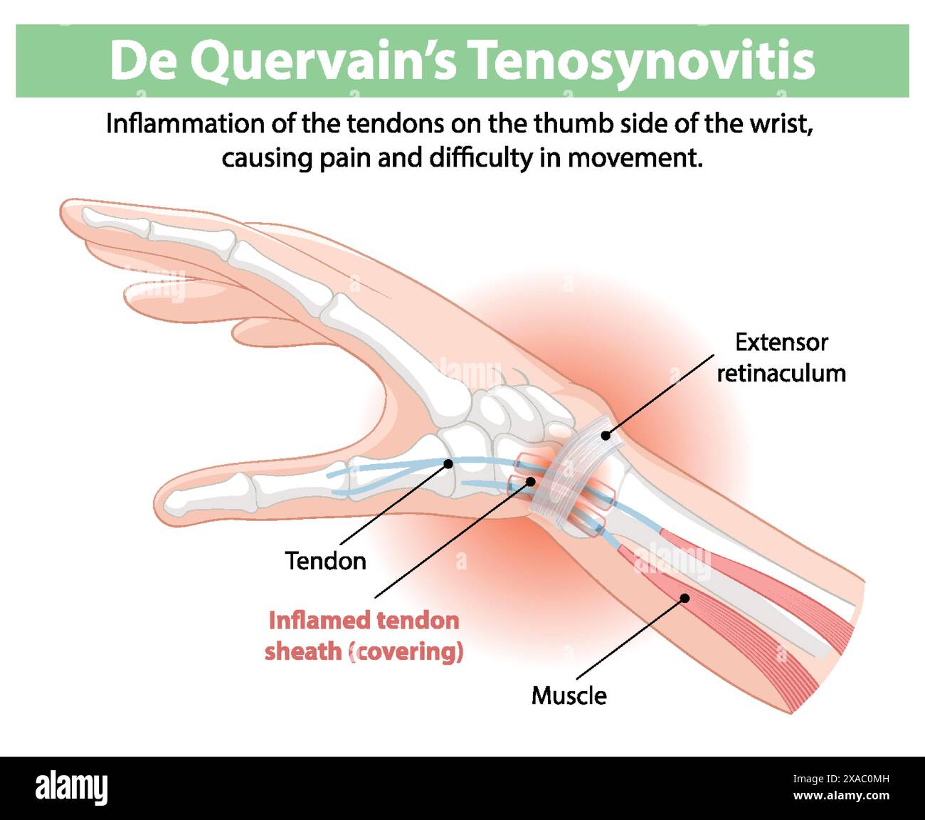 Inflammation des tendons du pouce causant des douleurs au poignet Illustration de Vecteur