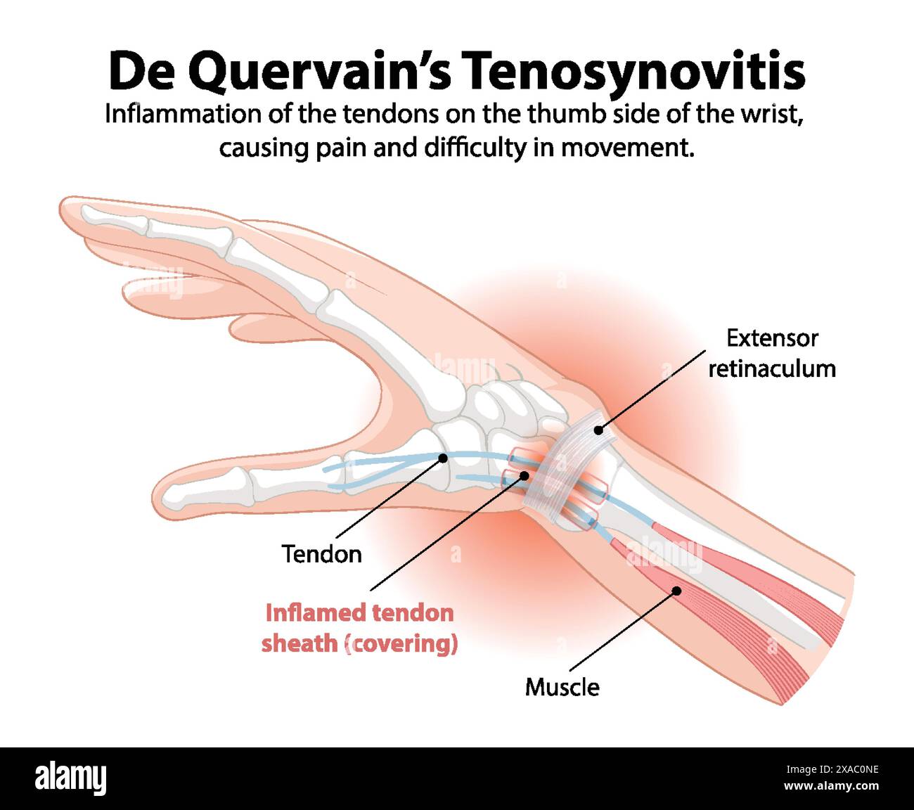 Gaine tendineuse enflammée dans le poignet Illustration de Vecteur