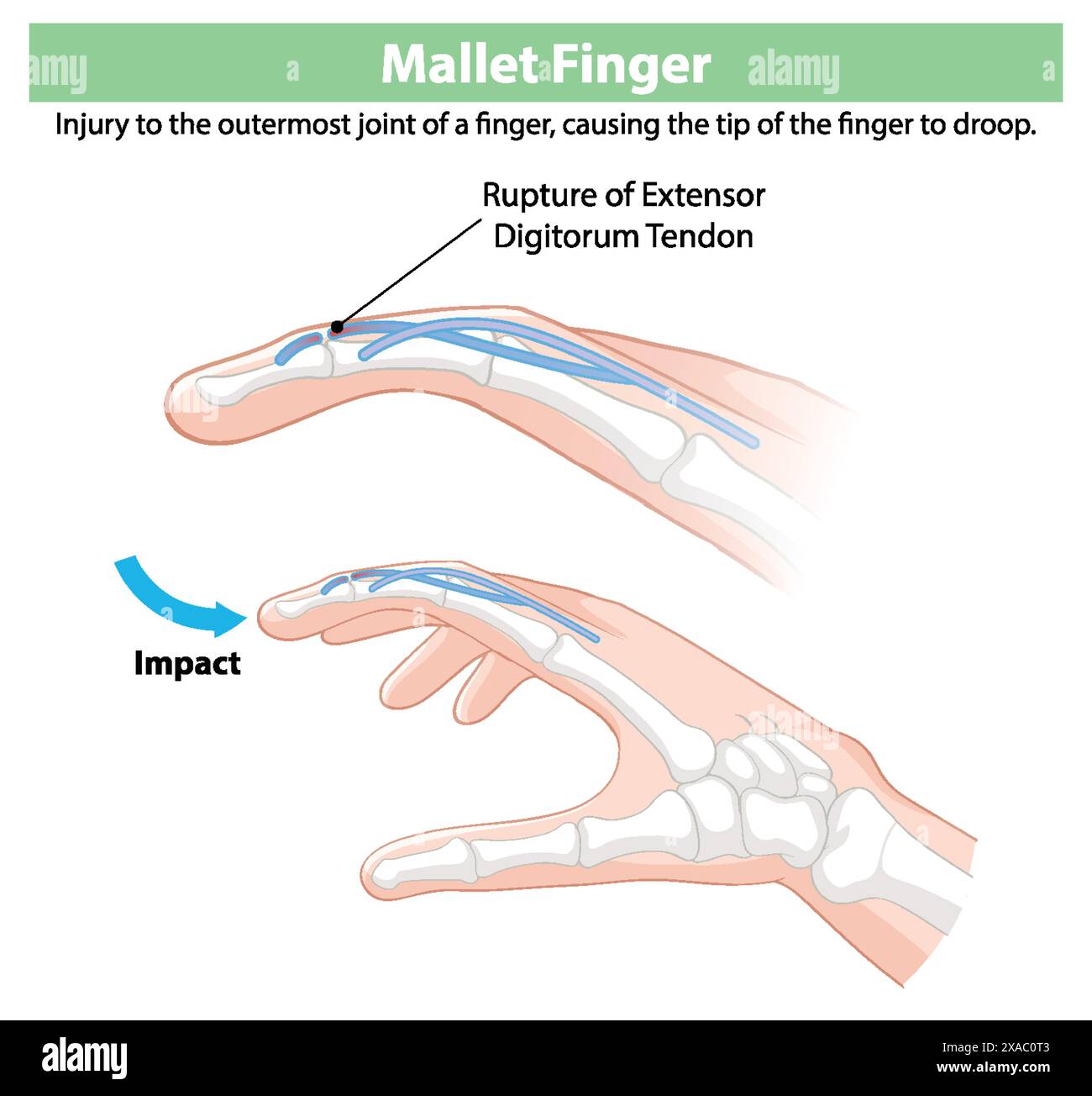 Montre une rupture du tendon de l'extenseur digitorum Illustration de Vecteur