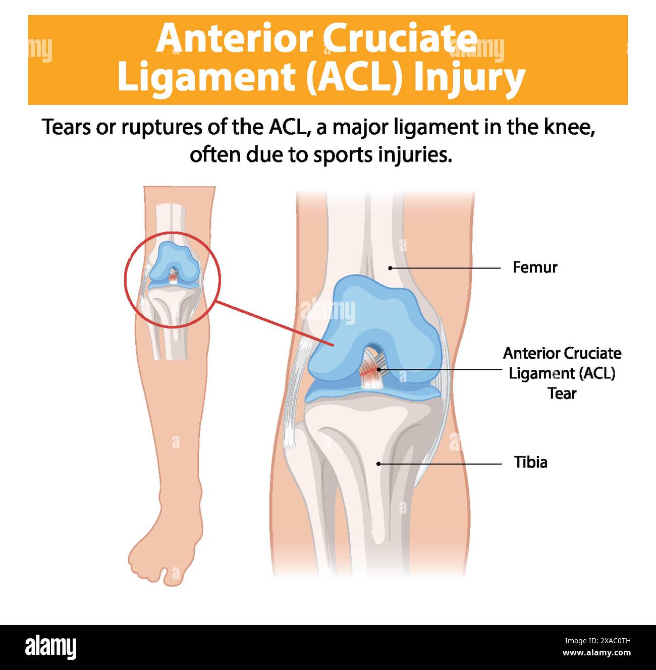 Illustration d'une déchirure du LCA dans l'articulation du genou Illustration de Vecteur