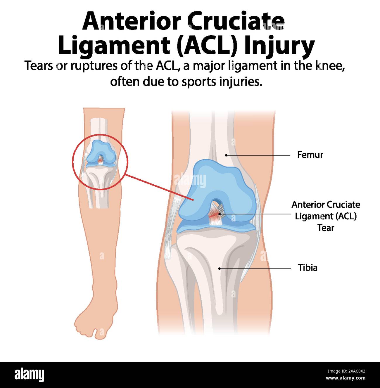 Illustration d'une déchirure ACL dans le genou Illustration de Vecteur