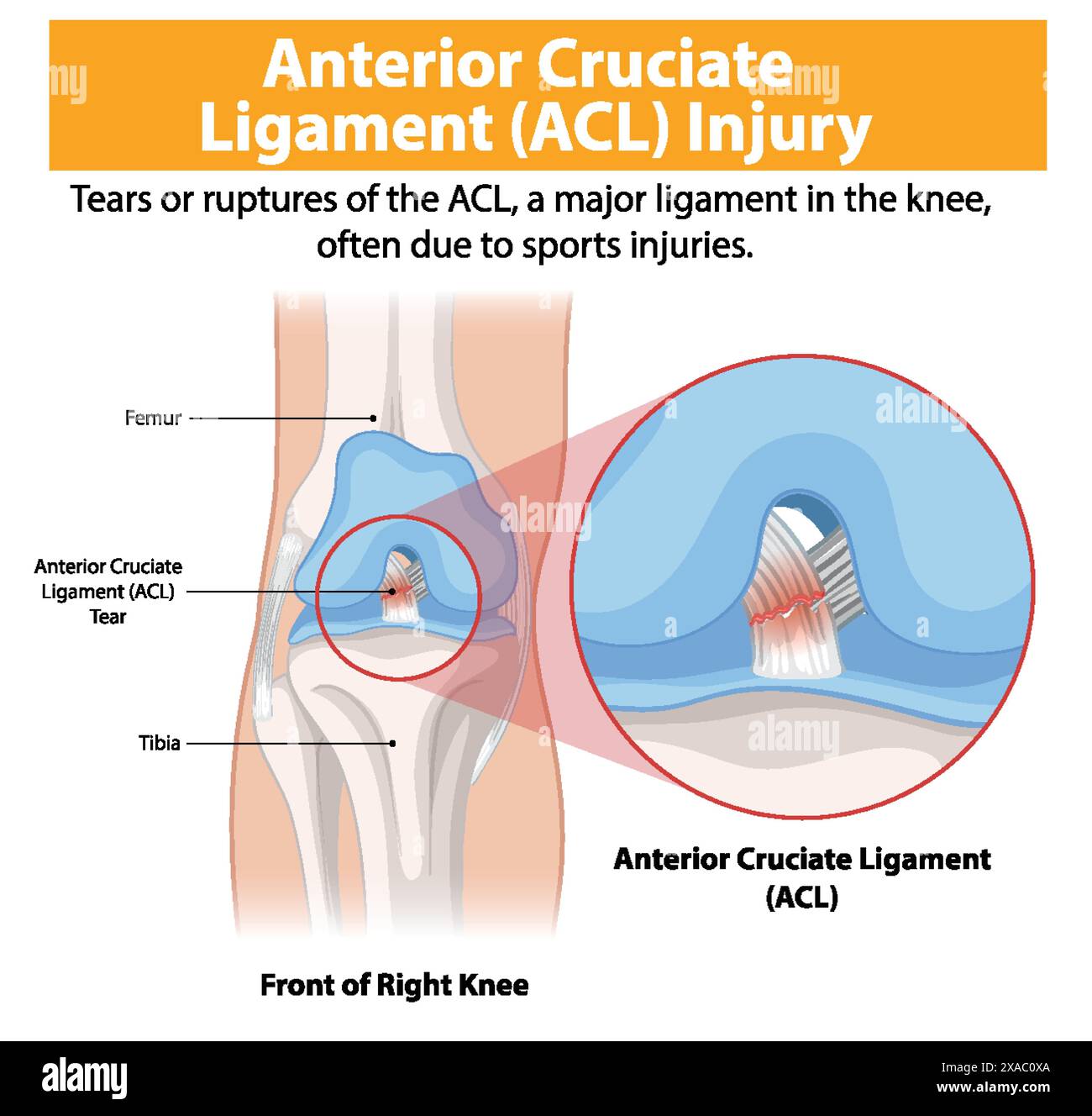 Illustration d'une déchirure de la LCA dans le genou droit Illustration de Vecteur