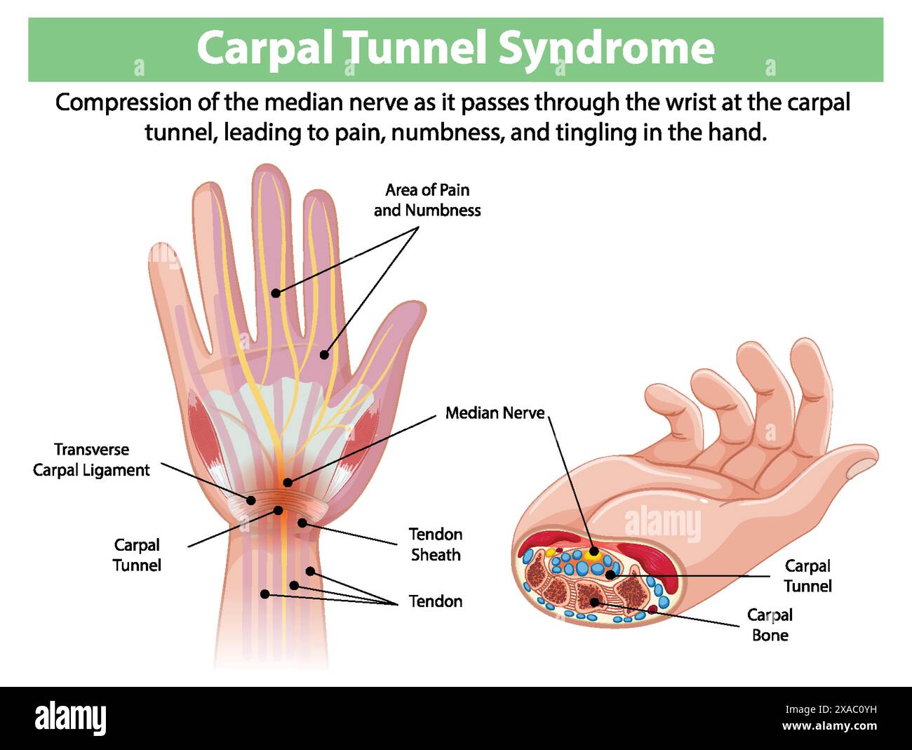 Schéma détaillé des symptômes du syndrome du canal carpien Illustration de Vecteur Schéma détaillé des symptômes du syndrome du canal carpien Illustration de Vecteur