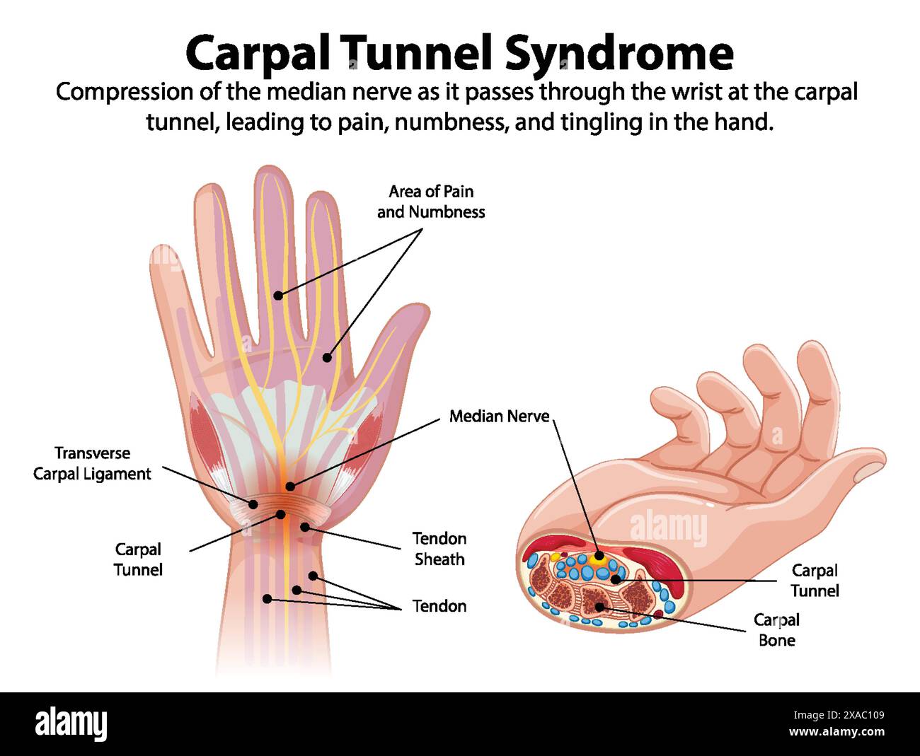 Schéma détaillé des symptômes du syndrome du canal carpien Illustration de Vecteur Schéma détaillé des symptômes du syndrome du canal carpien Illustration de Vecteur