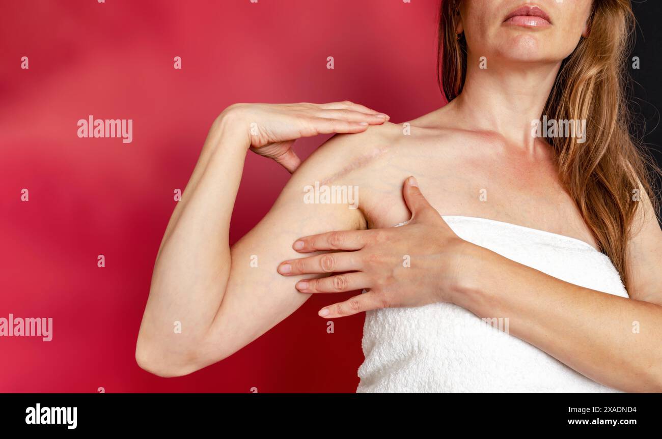 Cicatrice postopératoire sur l'épaule d'une femme. Une femme montre la cicatrice. Cicatrice après chirurgie après fracture osseuse du bras. Banque D'Images