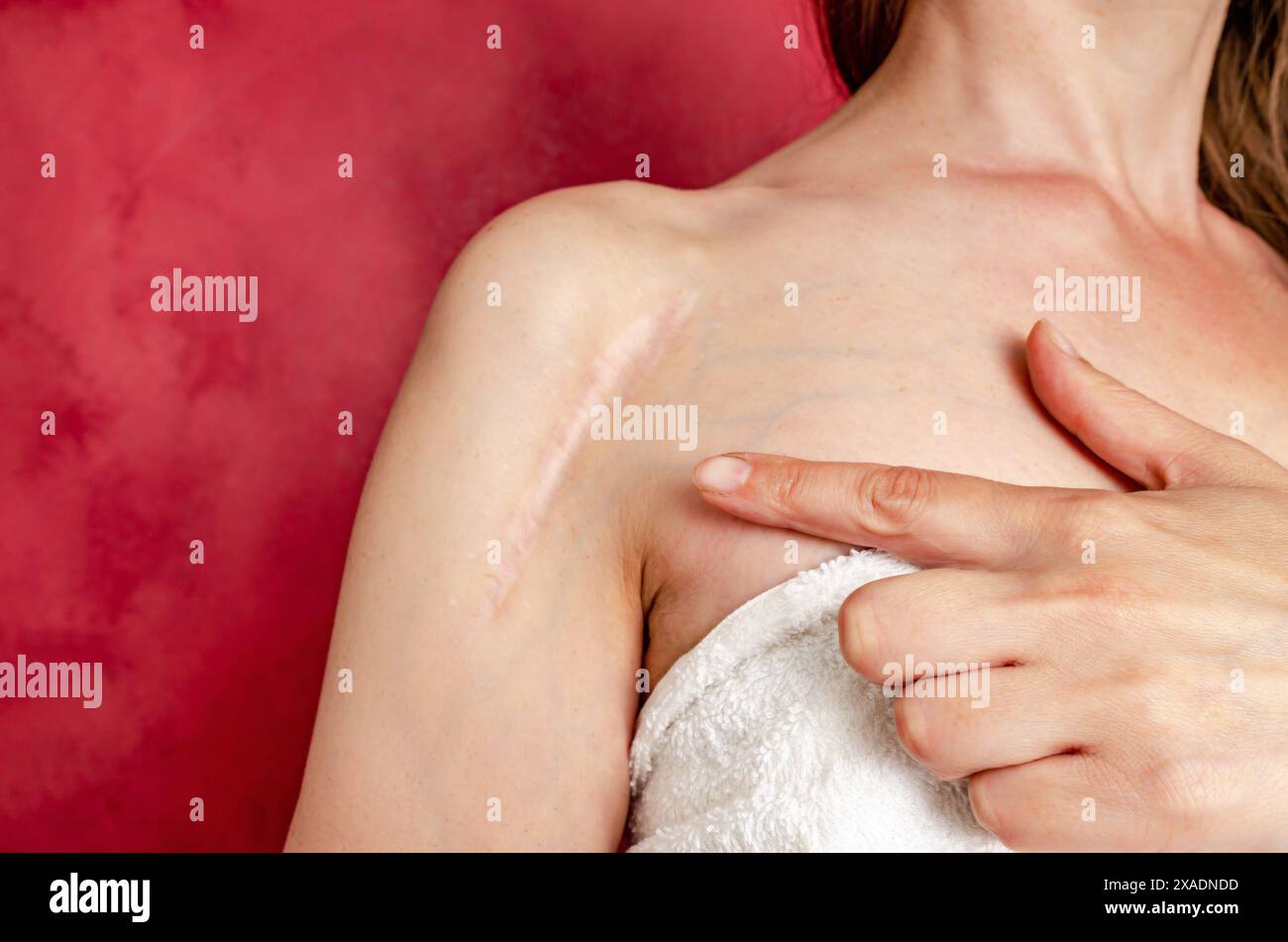 Cicatrice postopératoire sur l'épaule d'une femme. Une femme montre la cicatrice. Cicatrice après chirurgie après fracture osseuse du bras. Banque D'Images