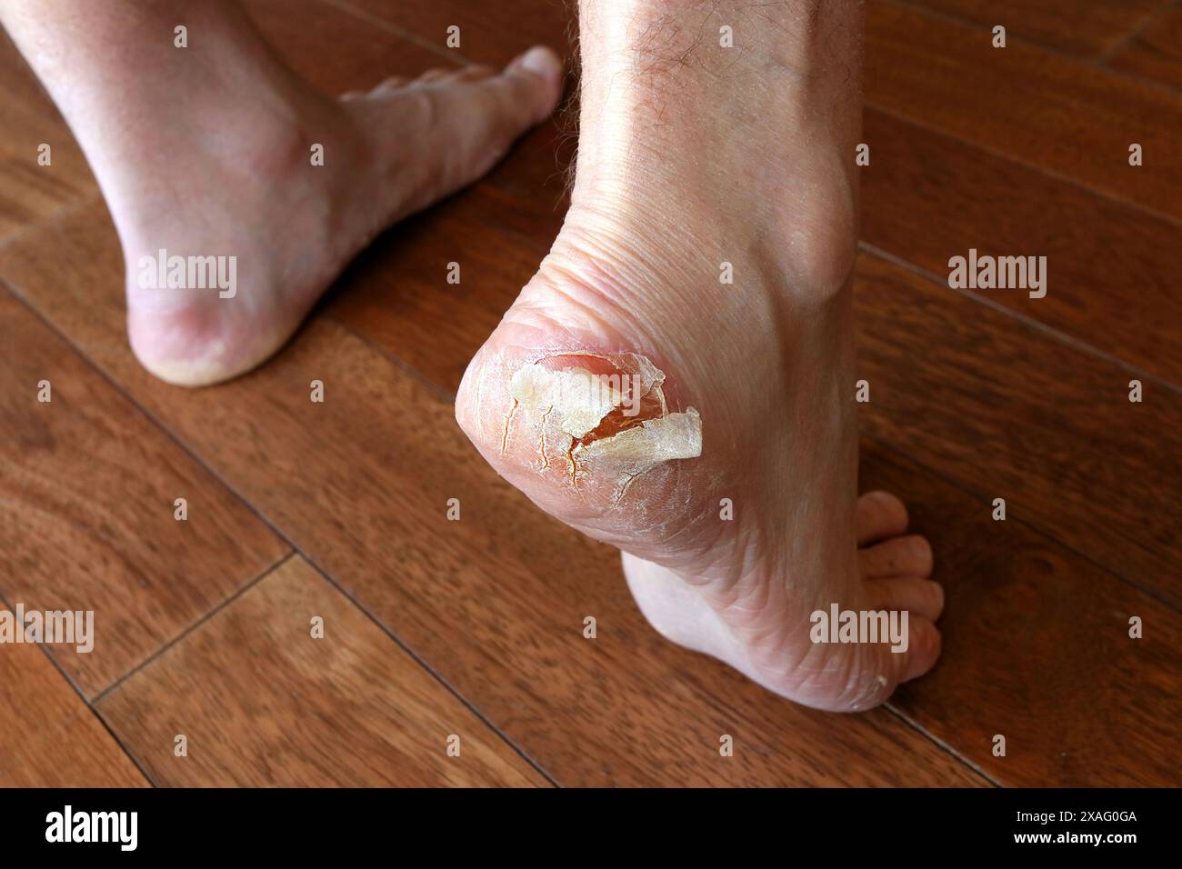 Gros plan des pieds secs. Pelage et pied fissuré. La peau se détache du talon. Infection fongique ou athlète pied, dermatite, psoriasis, pieds en sueur ou Banque D'Images