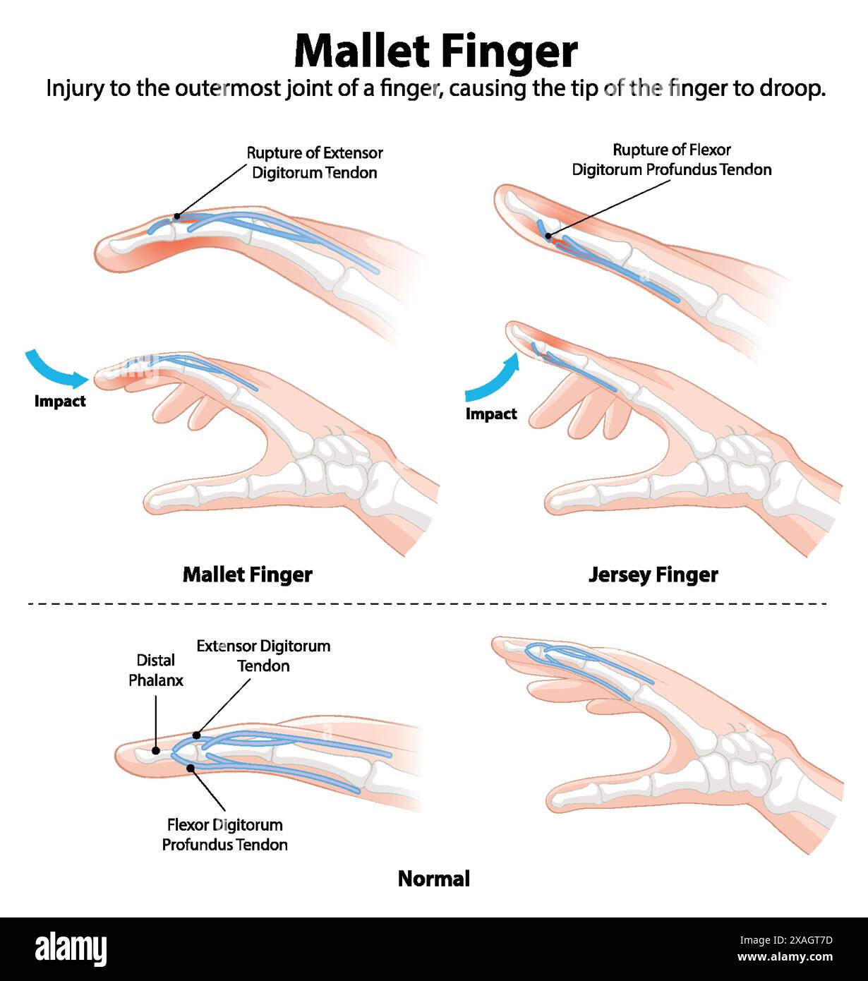 Illustration de lésions tendineuses des doigts et anatomie normale Illustration de Vecteur