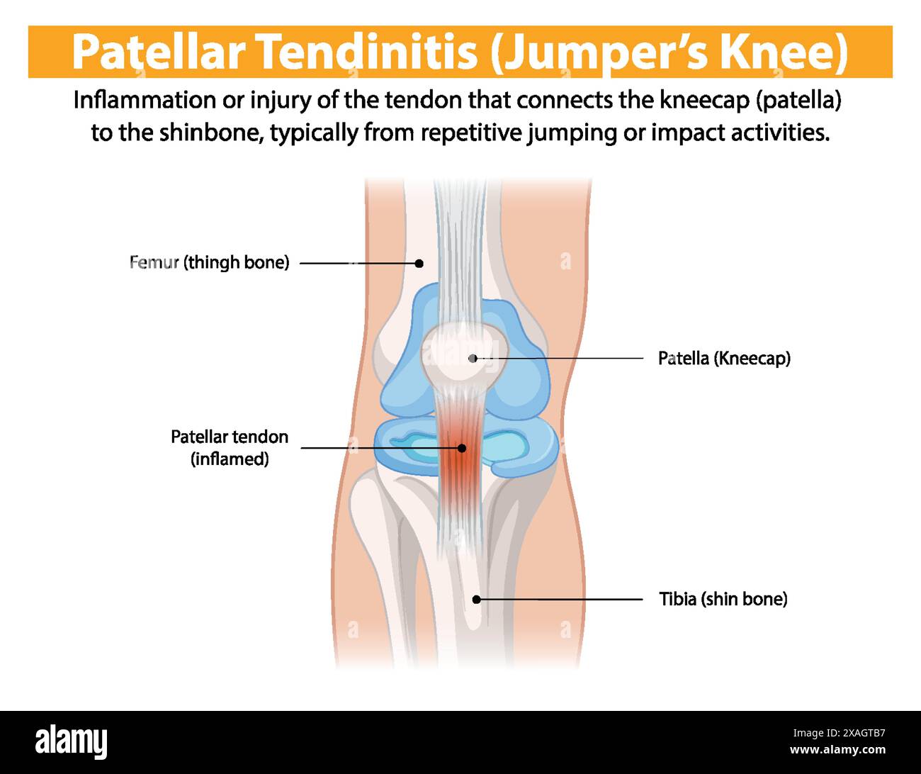 Inflammation du tendon rotulien dans le genou Illustration de Vecteur