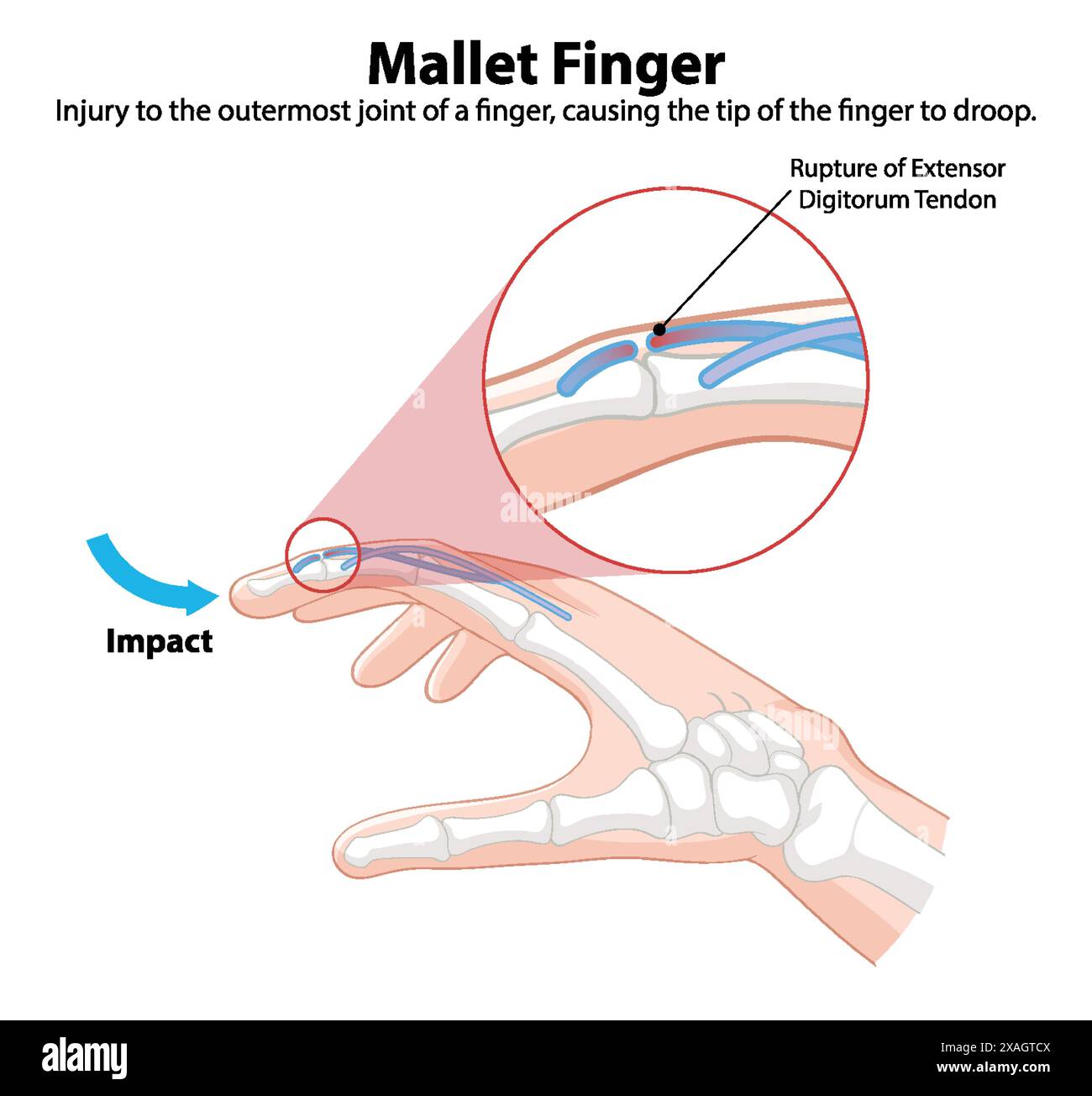 Schéma détaillé d'une blessure au doigt de maillet Illustration de Vecteur
