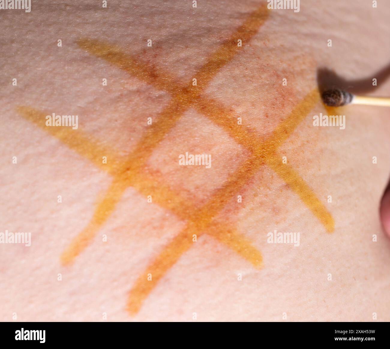 Application d'une maille d'iode au joint après injection intramusculaire du médicament. Traitement des infiltrats post-injection Banque D'Images