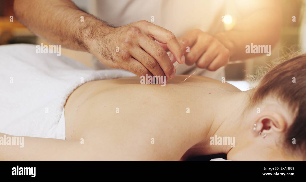 Acupuncture, dos et mains dans le spa pour se détendre avec un traitement client pour la guérison, le soulagement du stress ou la thérapie. Corps, aiguilletage sec et holistique avec Banque D'Images
