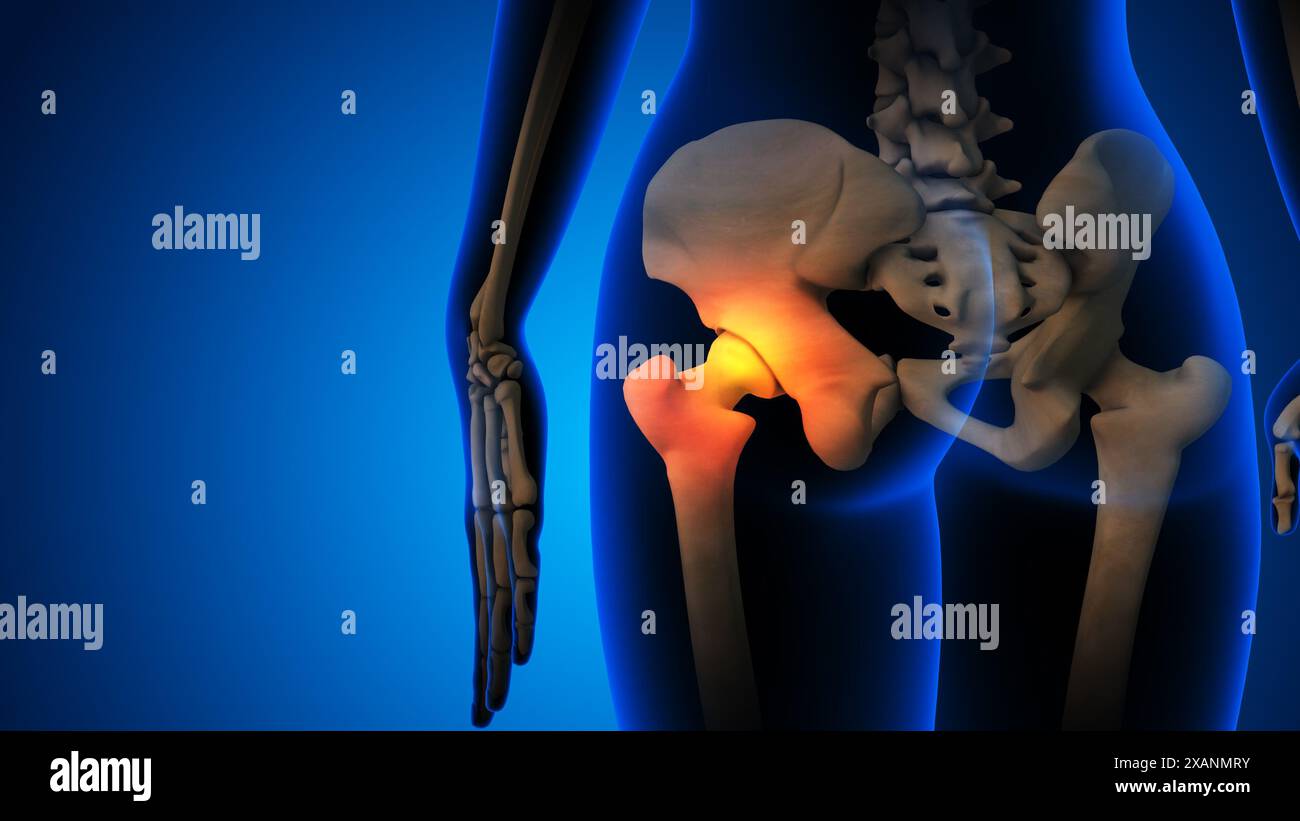 Squelette avec arthrose douleur articulaire de la hanche Banque D'Images