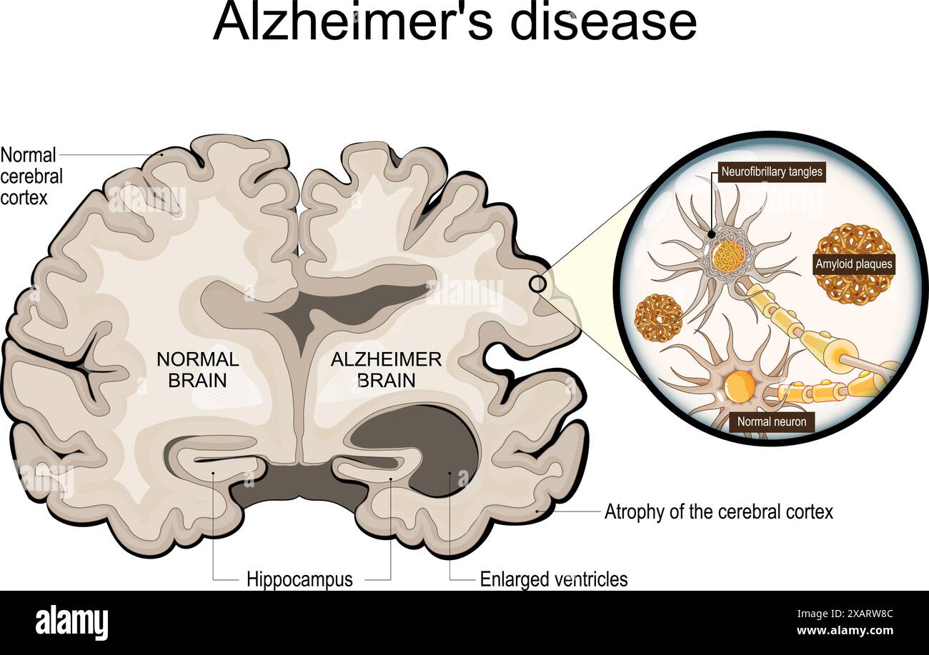 Maladie d'Alzheimer. Neurodégénérescence. Section transversale du cerveau normal et Alzheimer, avec atrophie du cortex cérébral, ventricules élargis et Hipp Illustration de Vecteur