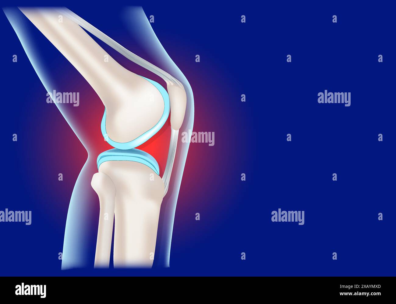 Inflammation de l'articulation du genou. Genou humain réaliste sur fond bleu. Illustration vectorielle conceptuelle Illustration de Vecteur