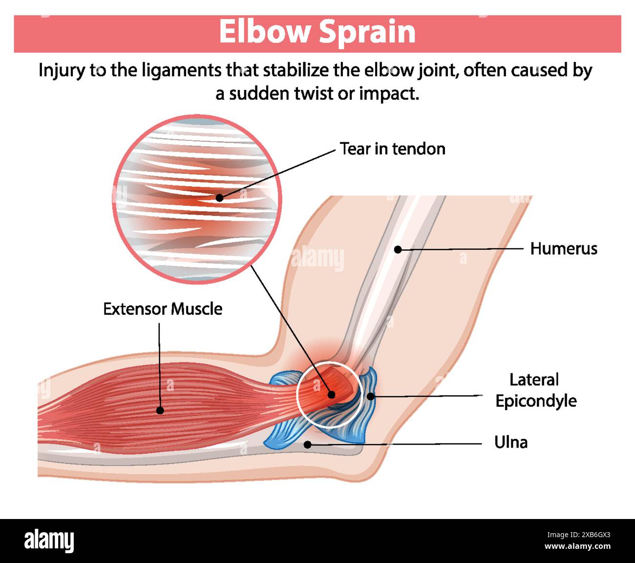 Schéma détaillé d'une entorse du coude Illustration de Vecteur