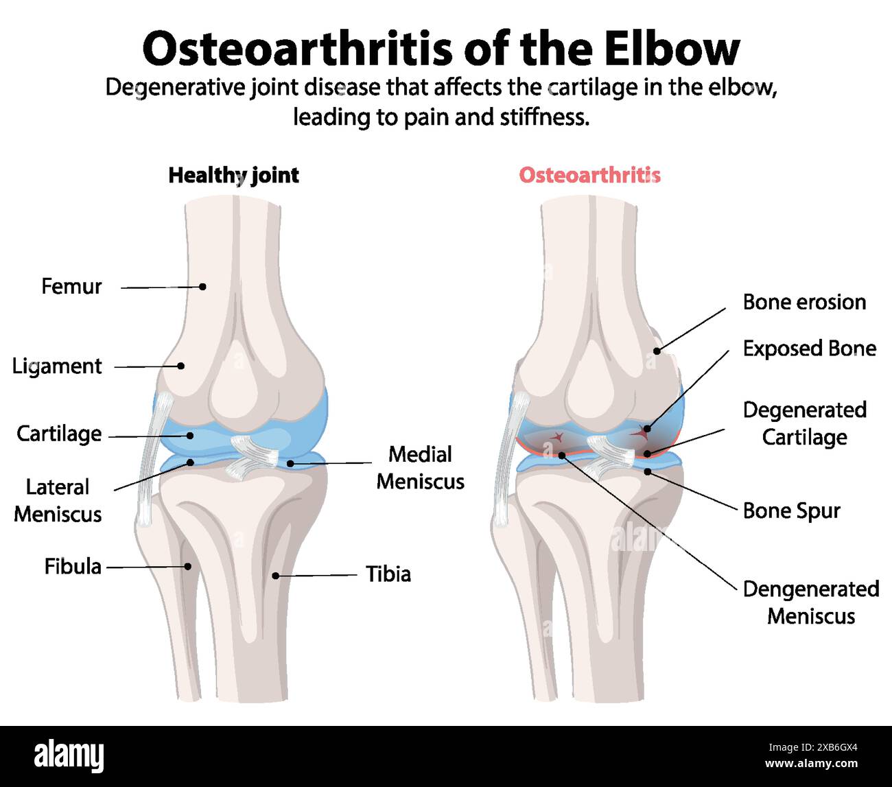 Comparaison des articulations saines et ostéo-arthritiques du coude Illustration de Vecteur