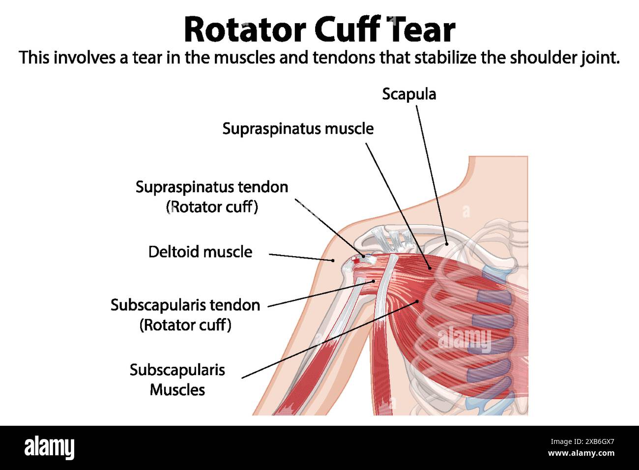 Anatomie détaillée de la déchirure de la coiffe des rotateurs de l'épaule Illustration de Vecteur