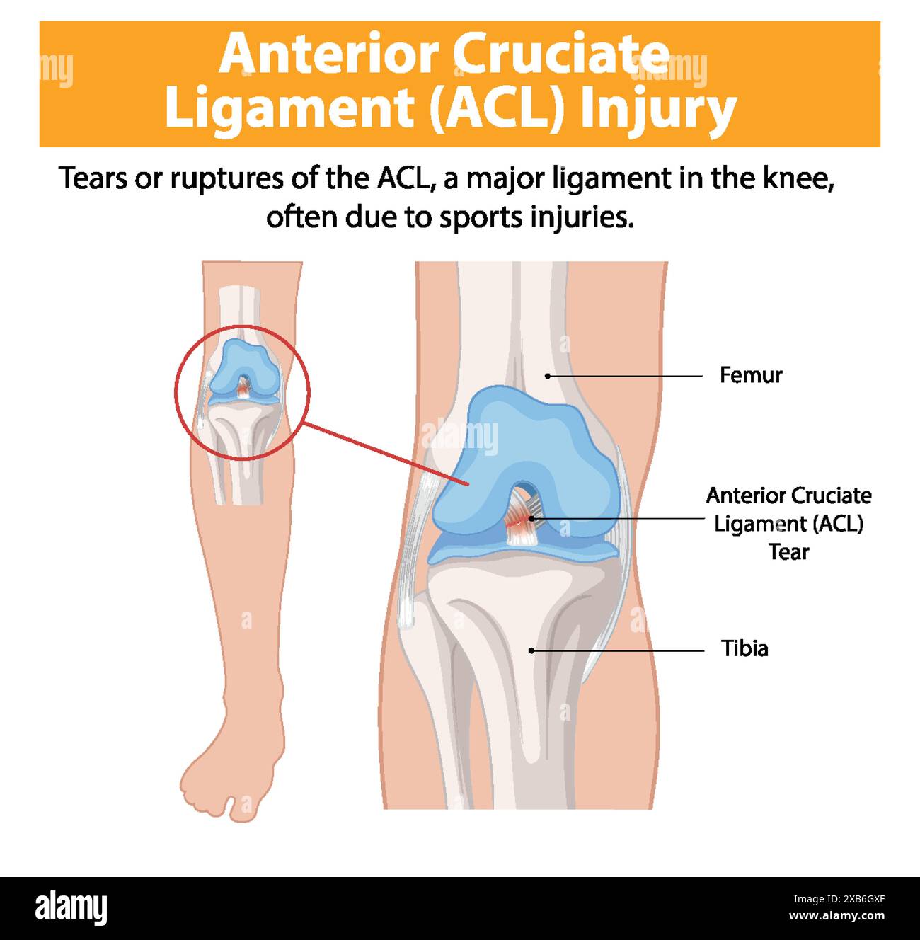 Illustration d'une déchirure ACL dans le genou Illustration de Vecteur