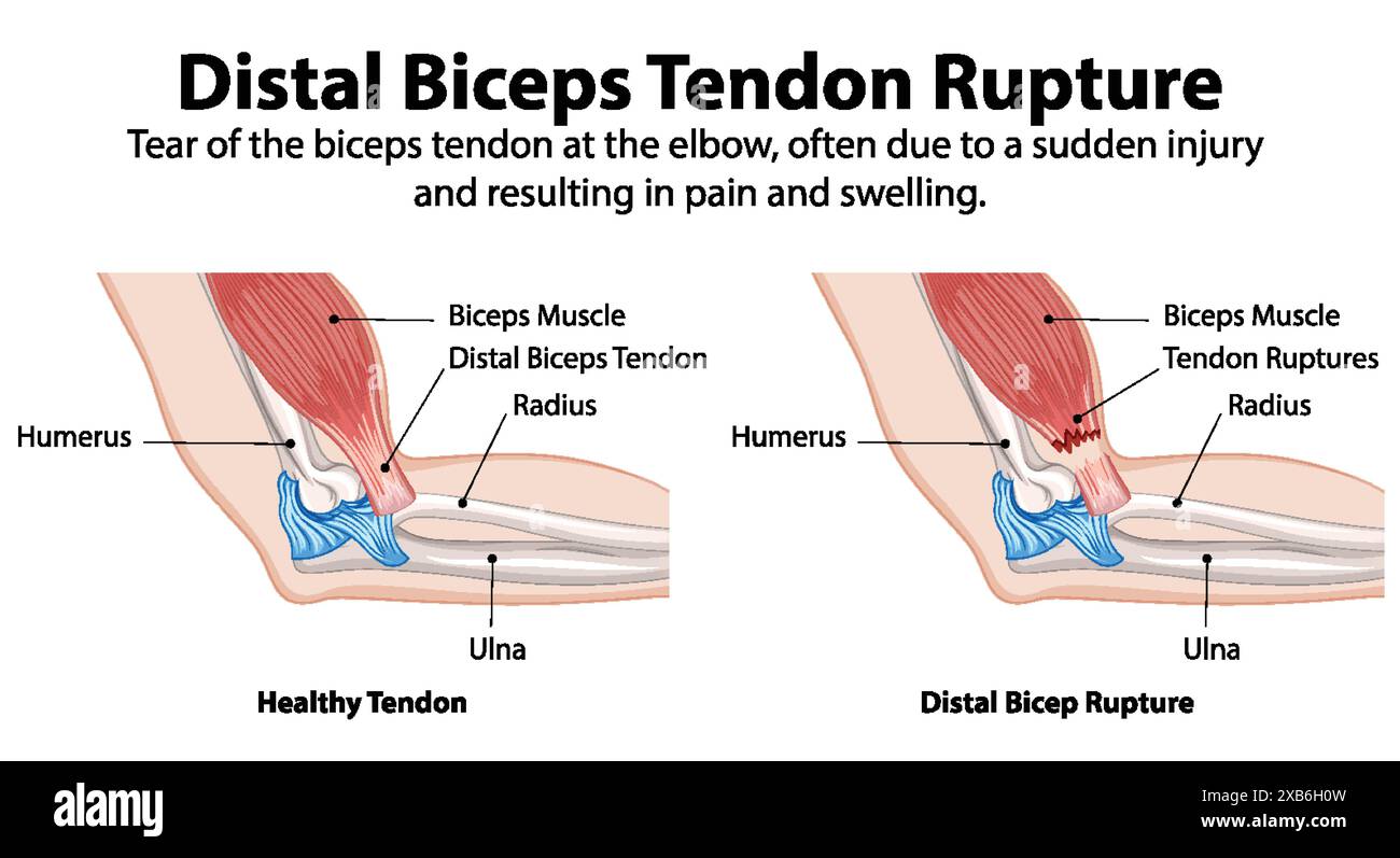 Comparaison tendon sain et tendon rompu Illustration de Vecteur
