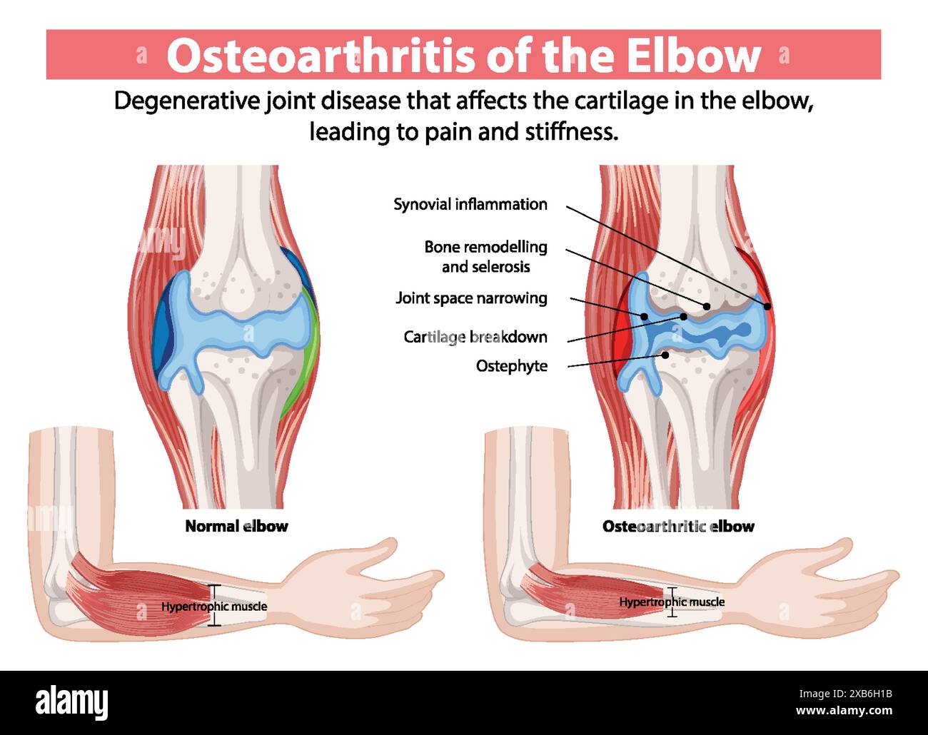 Comparaison des articulations normales et ostéo-arthritiques du coude Illustration de Vecteur