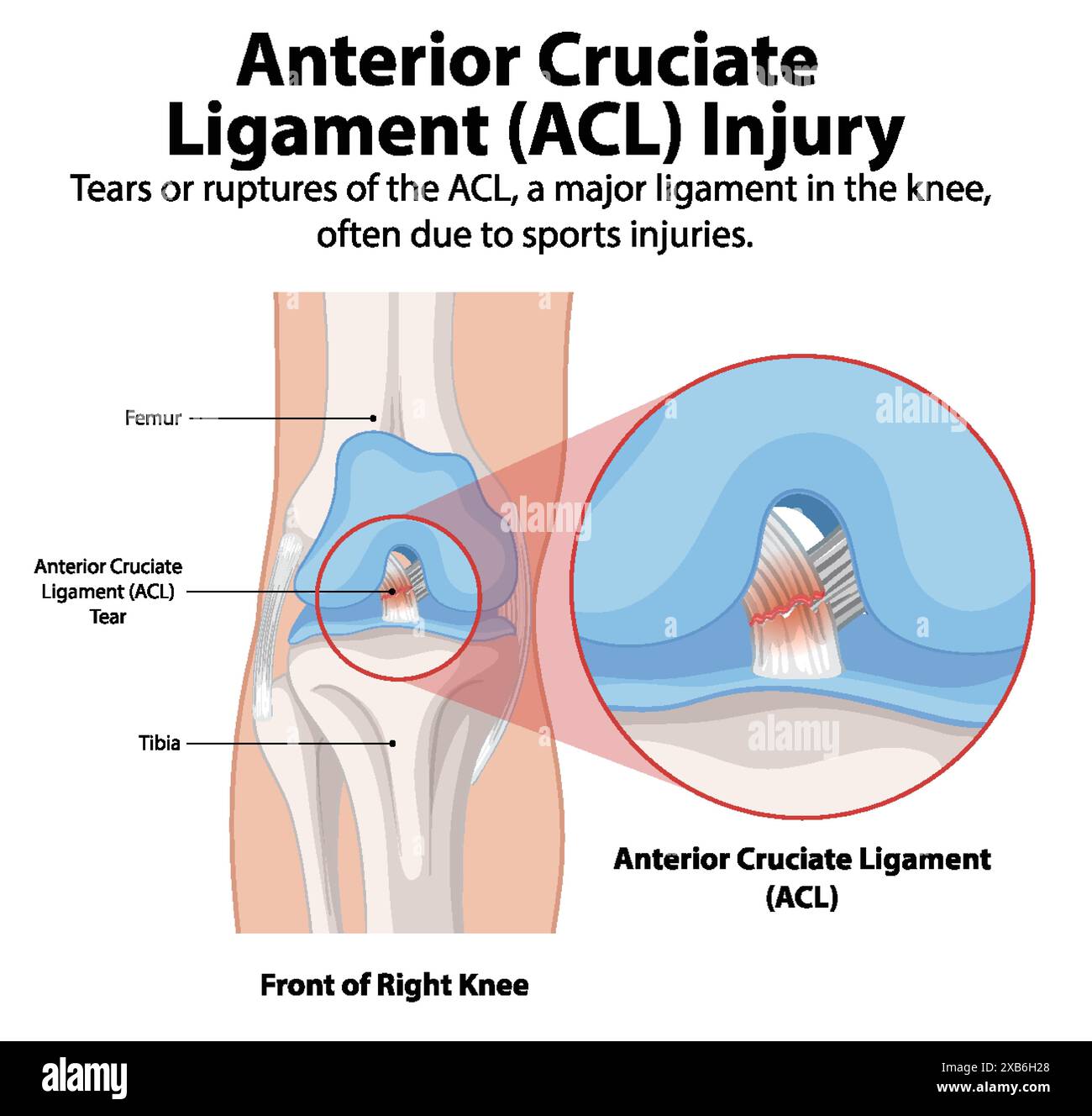 Illustration d'une déchirure ACL dans le genou Illustration de Vecteur