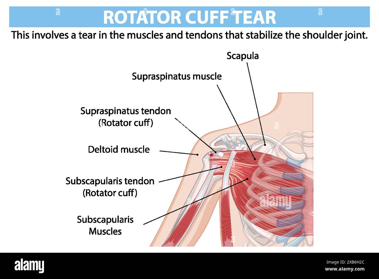 Anatomie détaillée de la déchirure de la coiffe des rotateurs de l'épaule Illustration de Vecteur