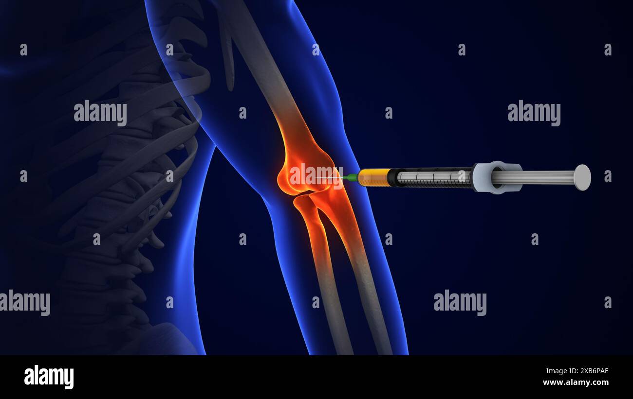 Anatomie traitement de l'articulation du coude humain Banque D'Images