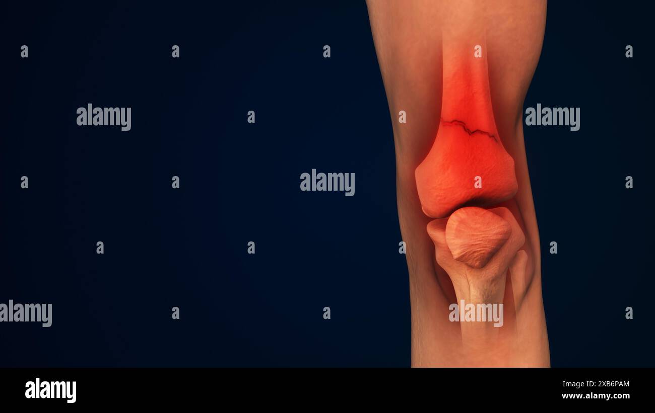 Fracture osseuse de jambe ou inflammation de l'articulation du genou humain Banque D'Images