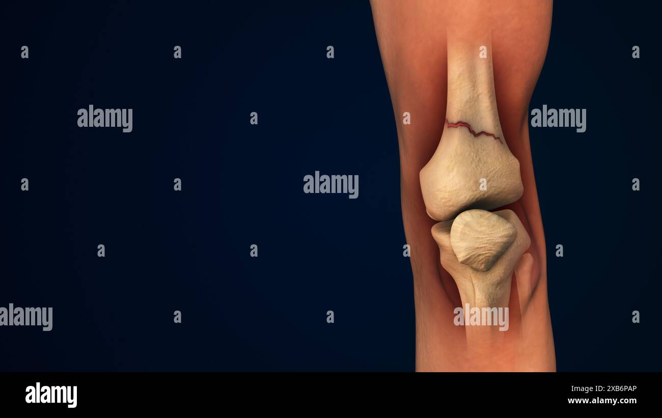 Fracture osseuse de jambe ou inflammation de l'articulation du genou humain Banque D'Images