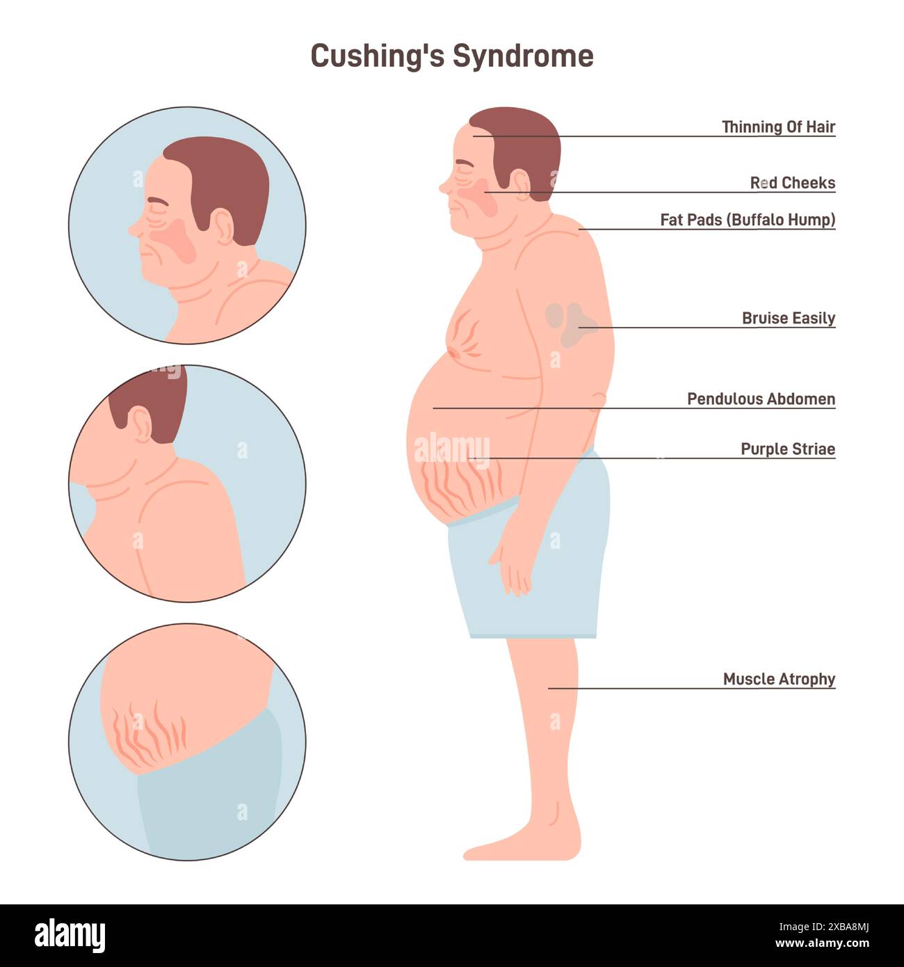 Maladie du syndrome de cushing Banque d'images vectorielles - Alamy