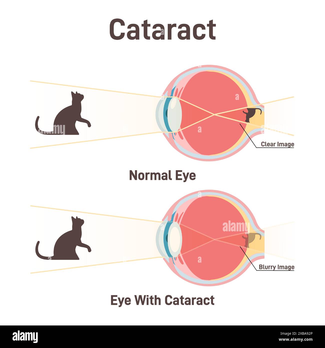 Cataracte. Opacification de la lentille, diminution de la vision. Structure anatomique en coupe transversale d'un oeil normal et d'un oeil avec cataracte. Illustration vectorielle plate Illustration de Vecteur